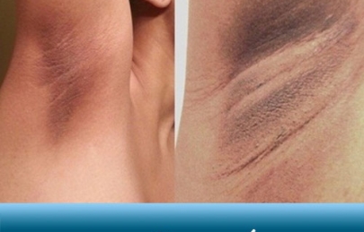 5 cách trị thâm nách tại nhà trong 7 ngày khỏi hẳn